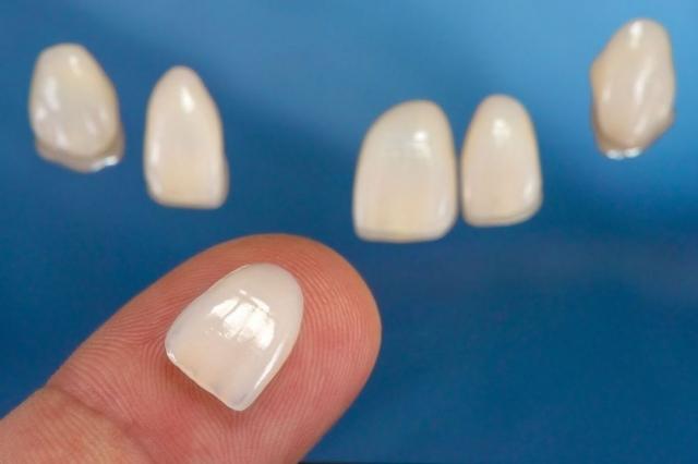 8 Types of Veneers: Which to Choose