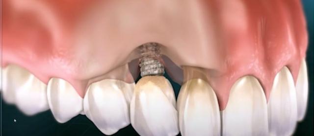 Common Causes of Dental Implant Failure