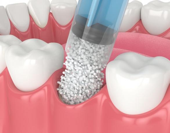 Everything You Should Know About Bone Grafting Before Dental Implants