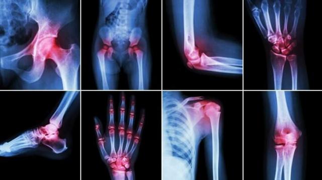 Everything You Should Know About Joint Supplements