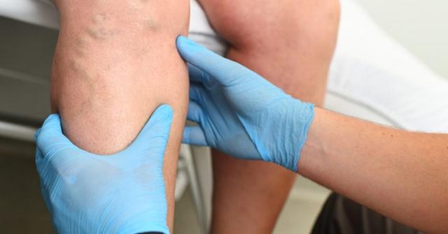 What is the Difference Between Sclerotherapy and Phlebectomy