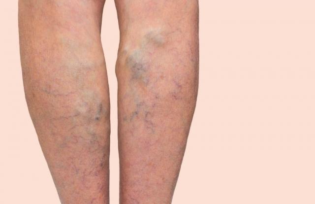 5 Myths About Varicose Veins: Are They Just a Cosmetic Issue?